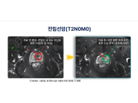 [기적을 현실로] 칼을 대지 않고 종양만 지우다: 전립선암 T2N0M0 완치 증례와 새로운 희망